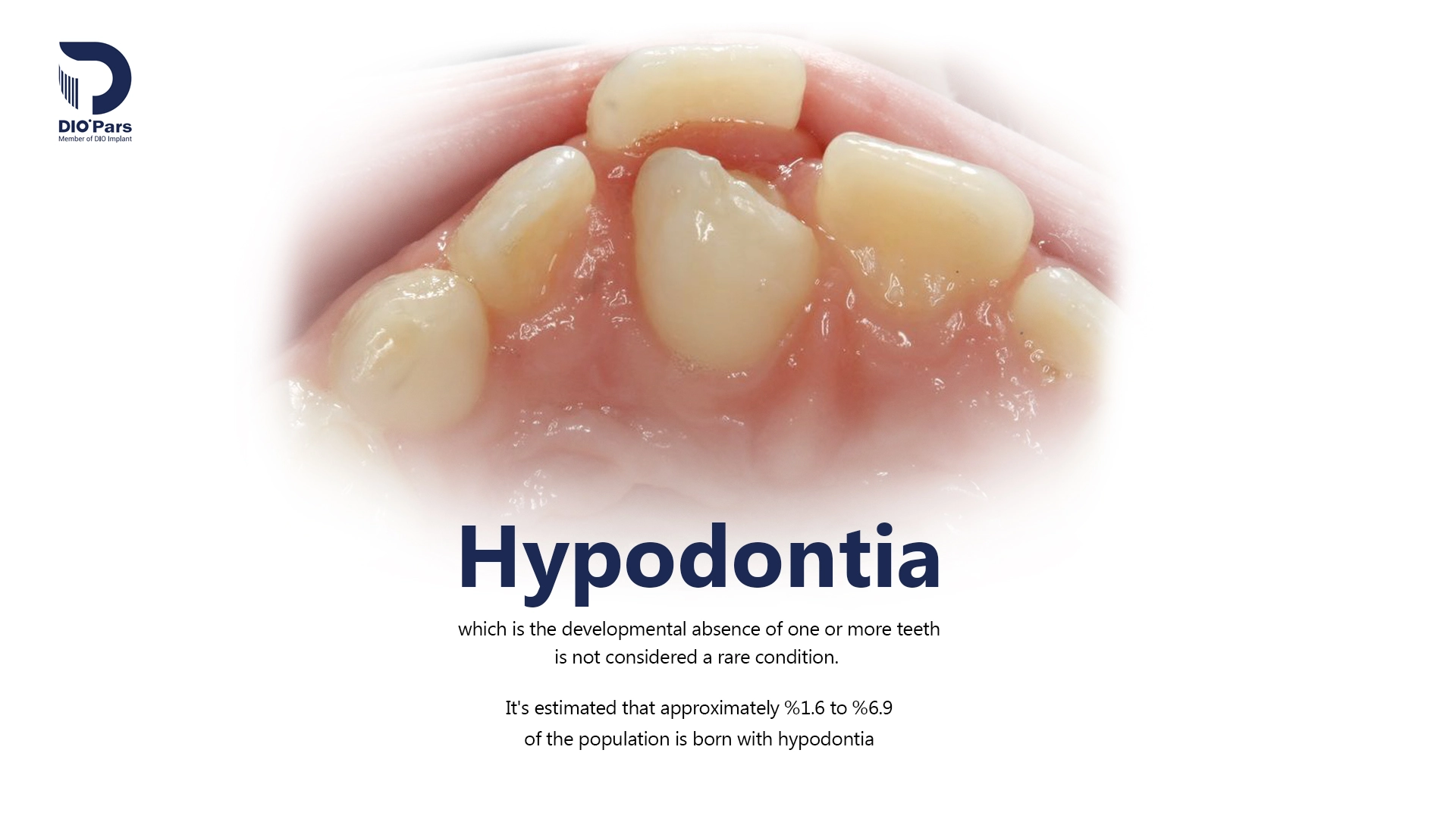 هایپودنتیا (Hypodontia) یا دندان اضافه چیست ؟