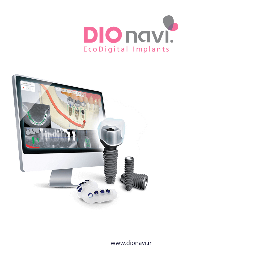 مزایا و معایب ایمپلنت های دیجیتال چیست ؟